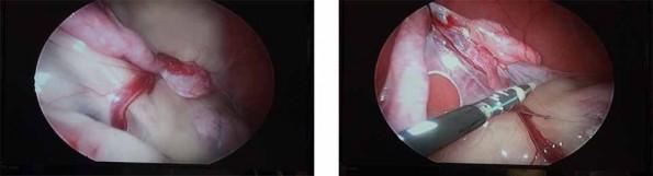 Laproscopic organ image